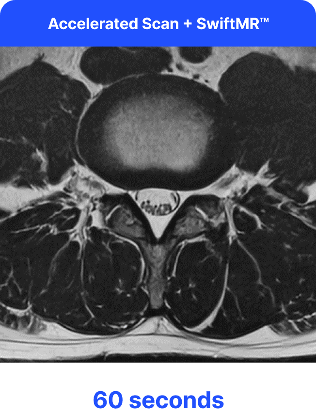Επιταχυνόμενη σάρωση MRI με βελτίωση SwiftMR στα 60 δευτερόλεπτα