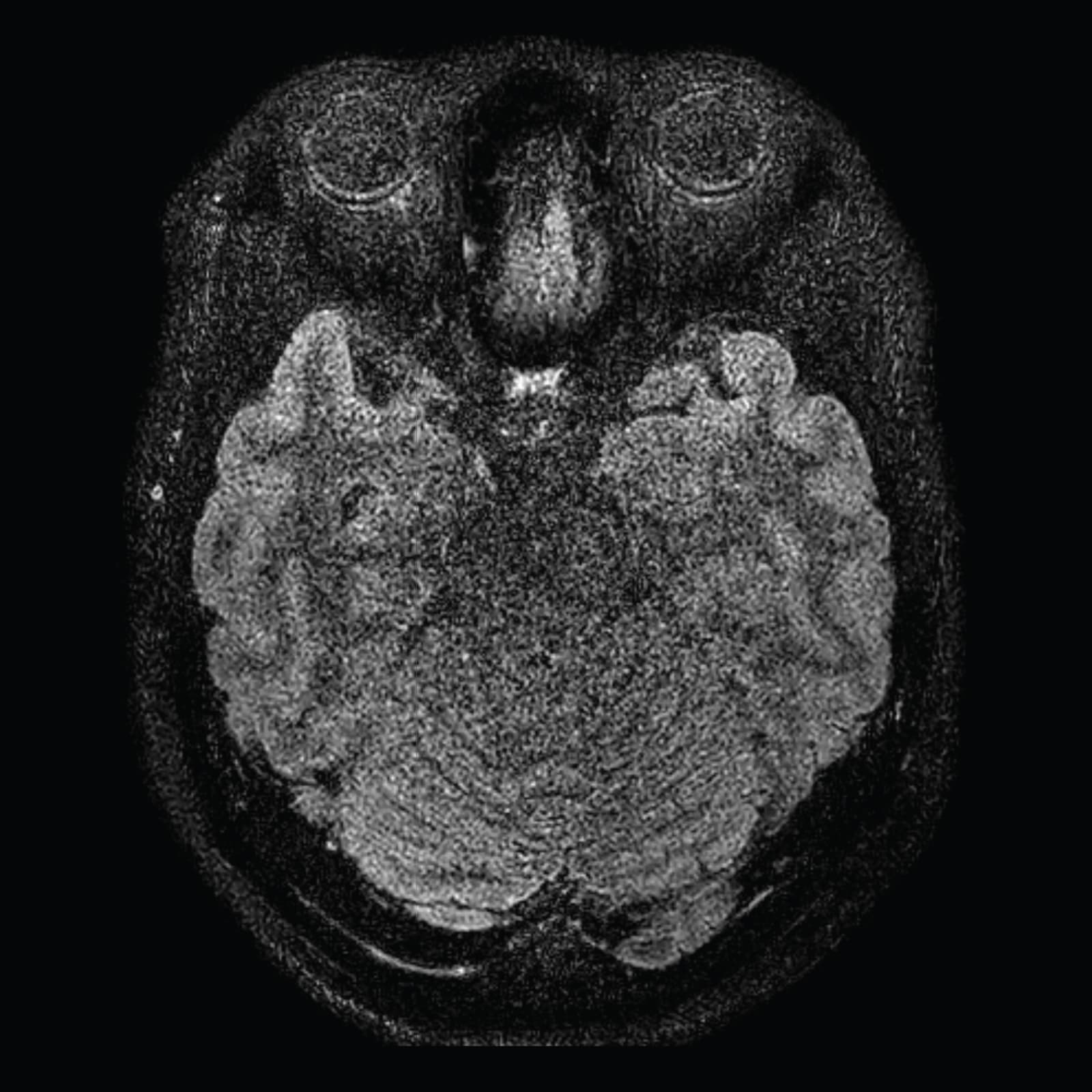 Brain - Conventional MRI