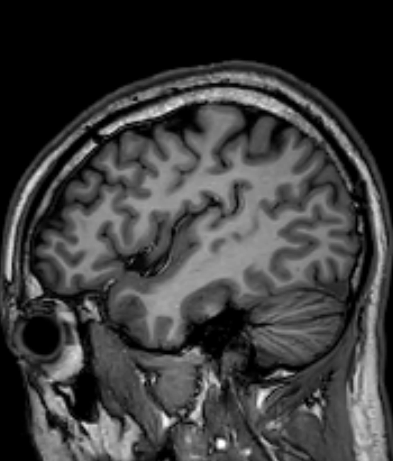 Brain T1WI - 3.0T Philips Ingenia CX - Conventional