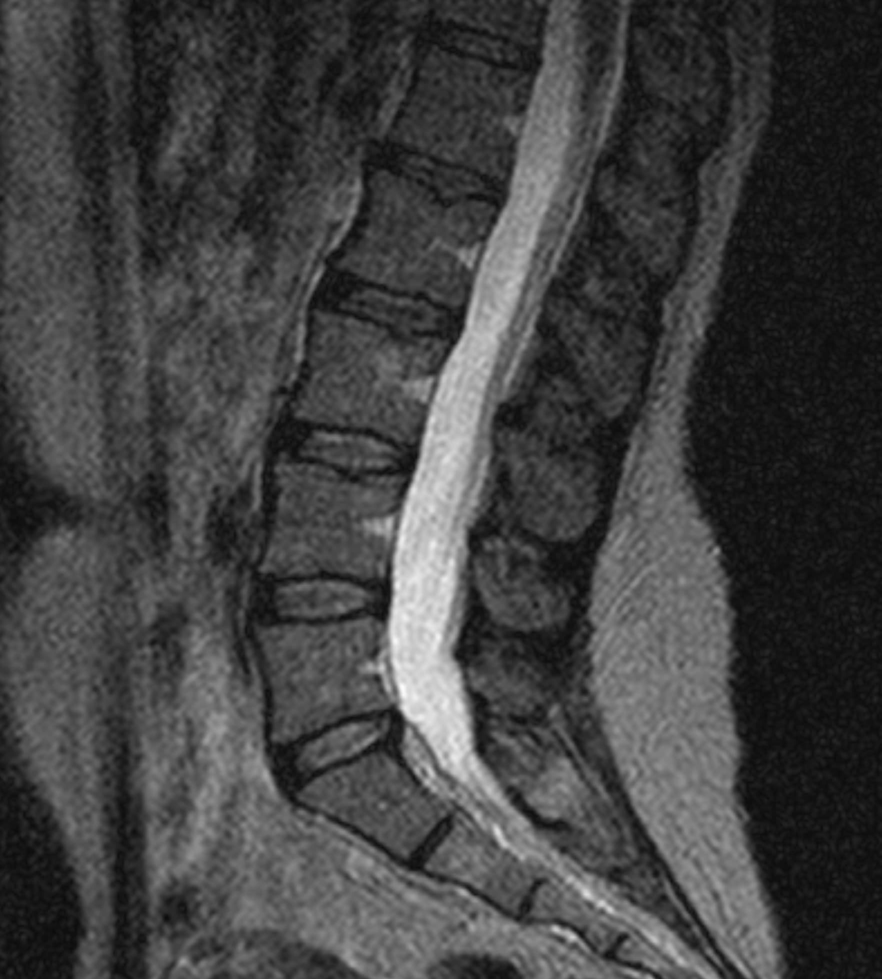 L-Spine T2WI - 0.38T Fujifilm APERTO Lucent - Conventional