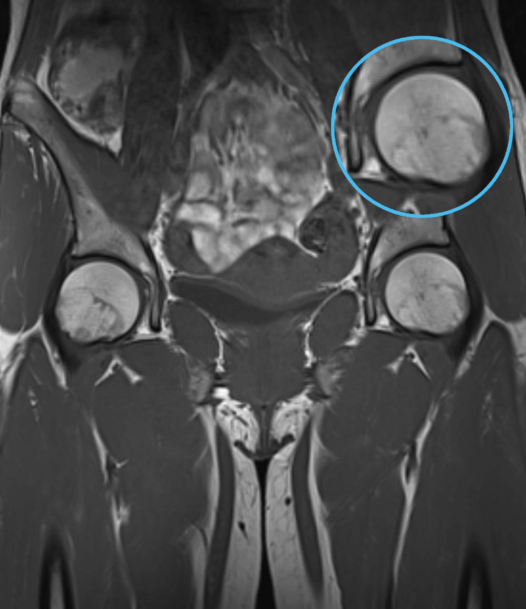 Hip T1WI - 3.0T Siemens MAGNETOM Skyra - Conventional