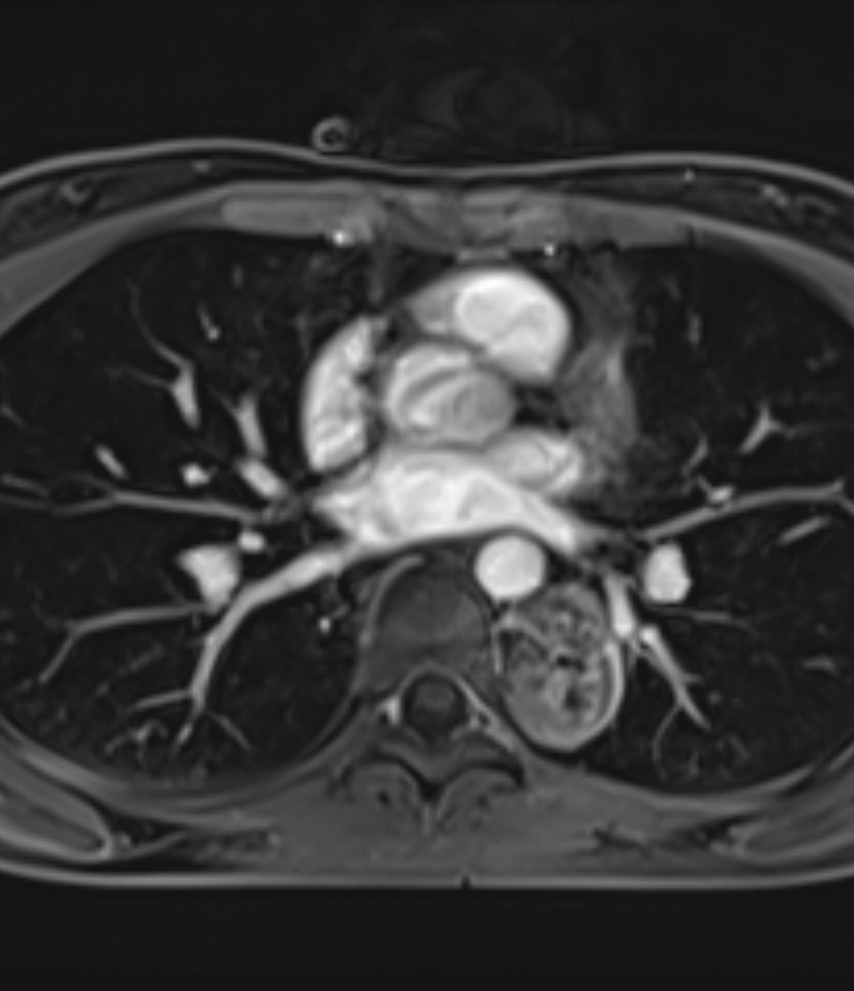 Chest CE T1WI - 3.0T Siemens MAGNETOM Skyra - Conventional