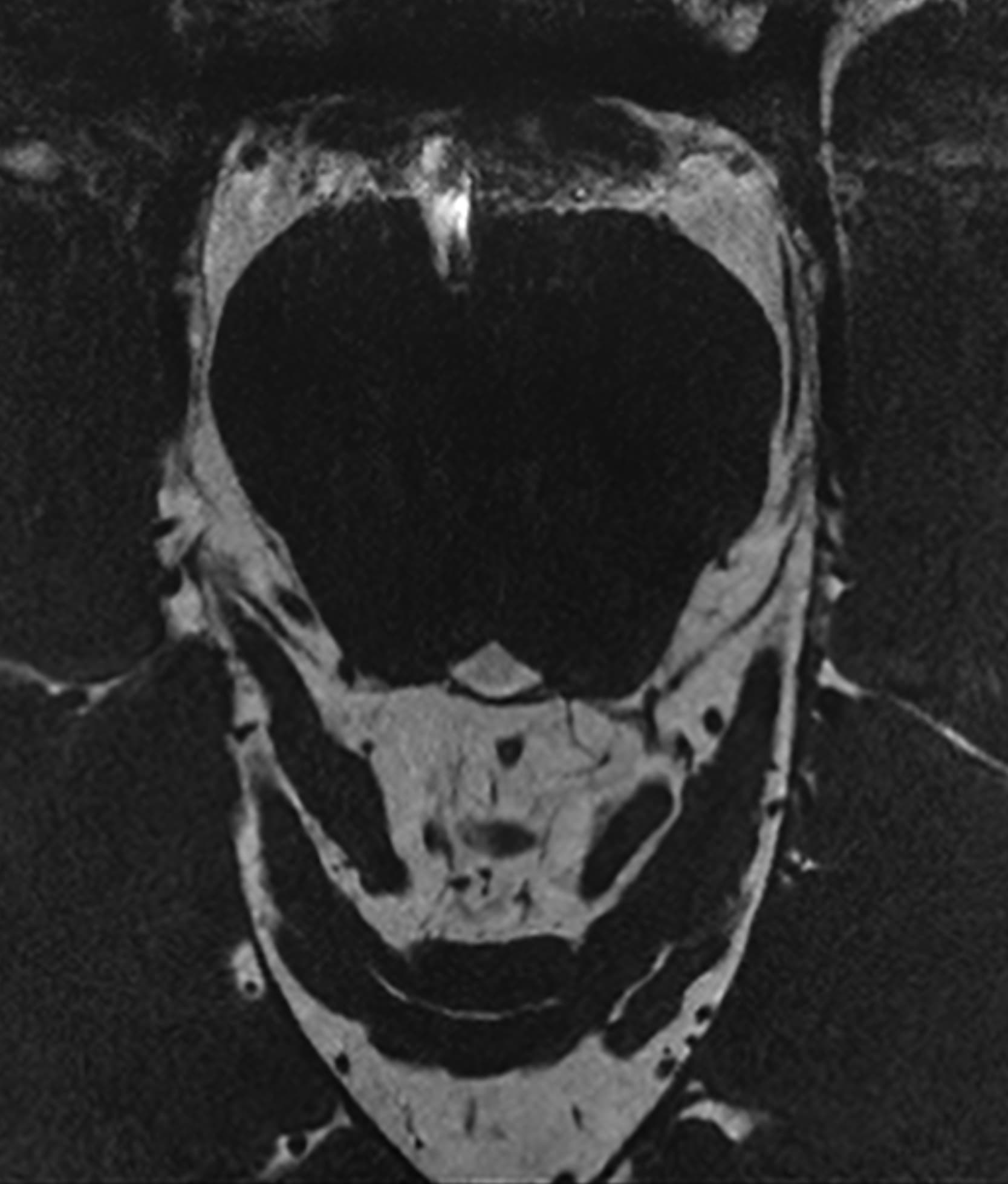Cranial Nerve T2WI - 3.0T Siemens MAGNETOM Vida - SwiftMR
