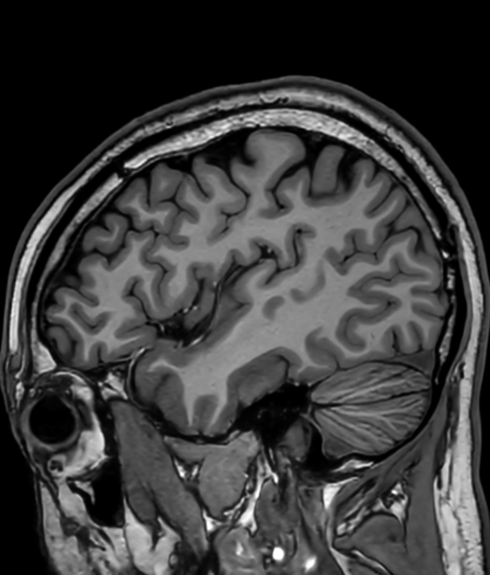 Brain T1WI - 3.0T Philips Ingenia CX - SwiftMR
