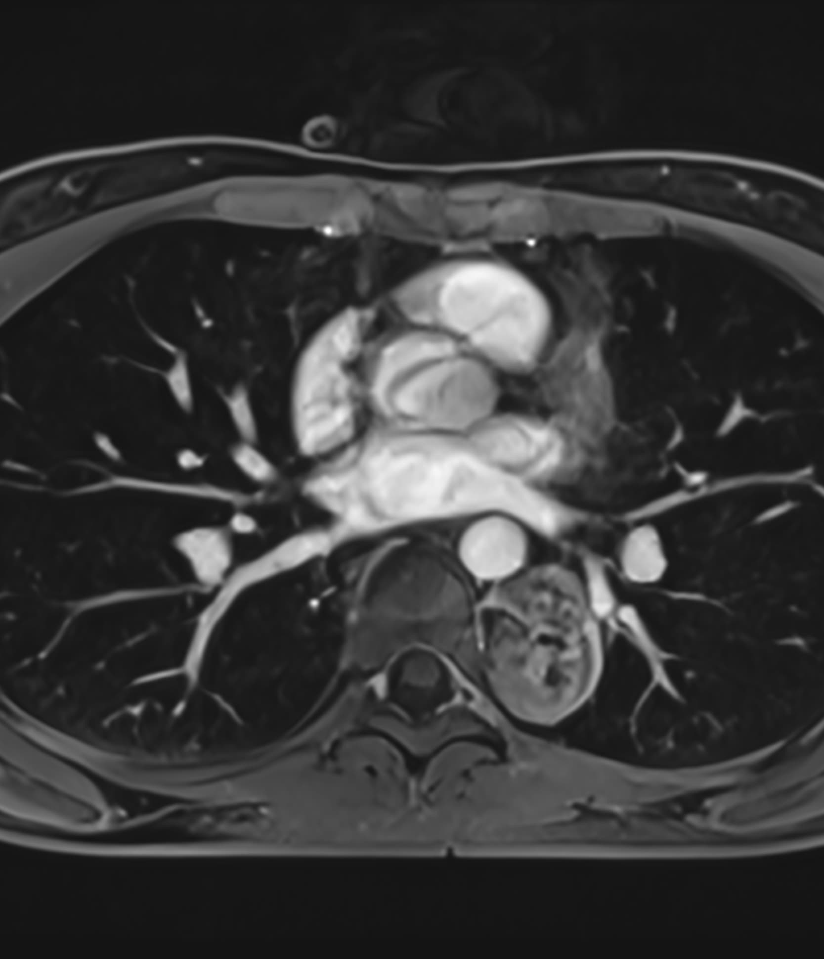 Chest CE T1WI - 3.0T Siemens MAGNETOM Skyra - SwiftMR