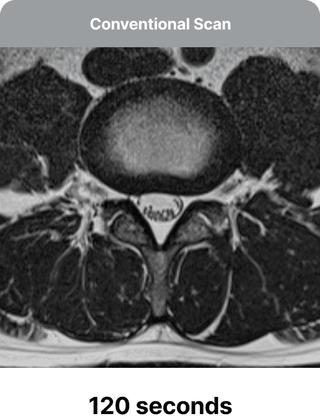 Συμβατική σάρωση MRI στα 120 δευτερόλεπτα